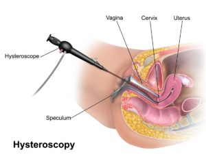 Why-Hysteroscopy is important