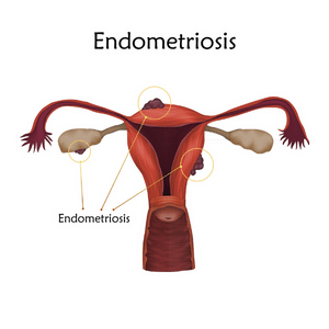 Endometriosis and Infertility